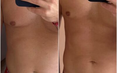 Kryolipolyse – Fett weg mit Kälte